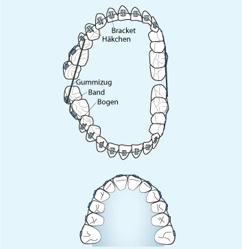 feste-zahnspange_normale-brackets.jpg 